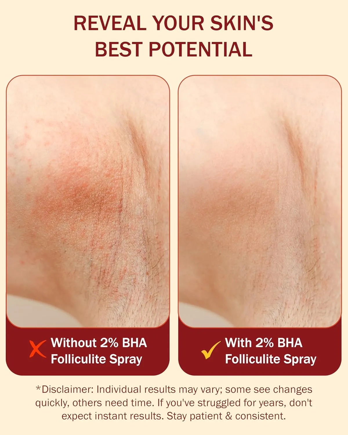 2% BHA Folliculitis Body Oil Spray - Salicylic Acid Body Mist with Tea Tree Oil & Aloe Vera - Spray Moisturizer for Dry Skin, Clogged Pores & Irritation, 4 fl. oz